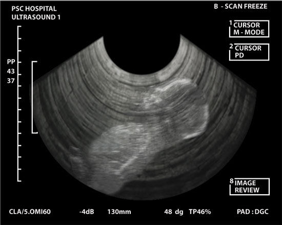 Ultrasound