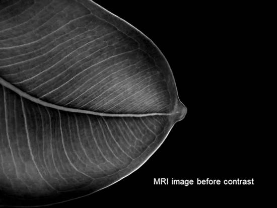 M.R.I. of right breast