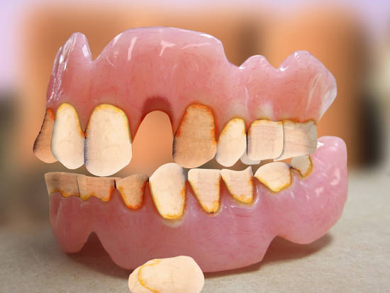 Worn out dentures