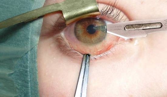 Eye surgery