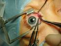 Eye Surgery