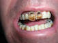 rust teeth 